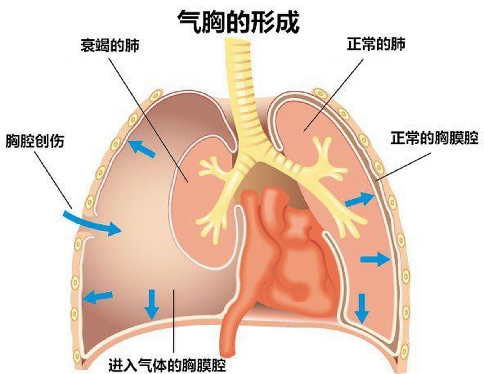 震惊！高瘦男性竟成气胸高危人群，背后原因让人细思极恐！